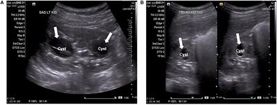 GANAB and PKD1 Variations in a 12 Years Old Female Patient With Early Onset of Autosomal Dominant Polycystic Kidney Disease